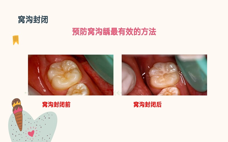 儿童龋病预防