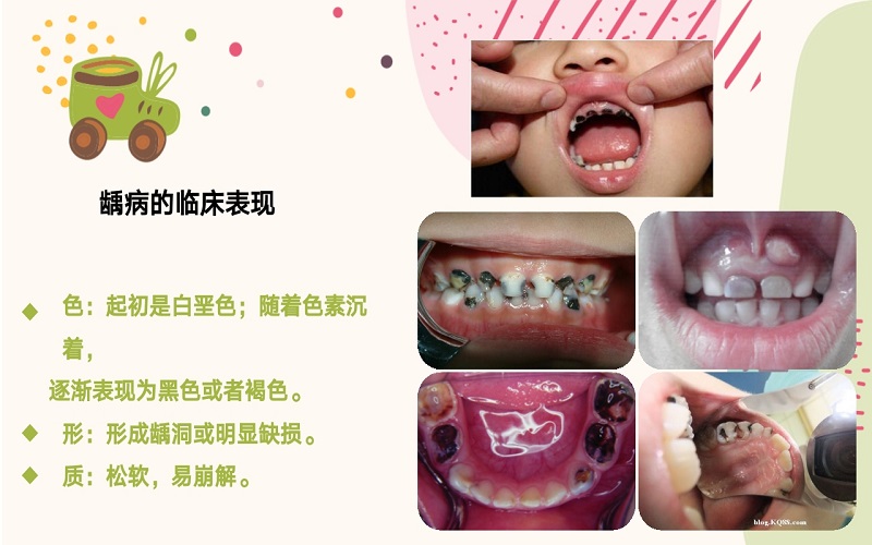 儿童龋病预防