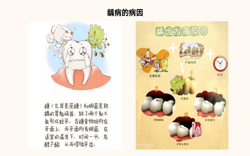 儿童龋病预防